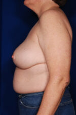 Breast Reduction