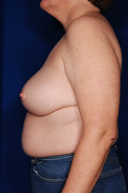 Breast Reduction