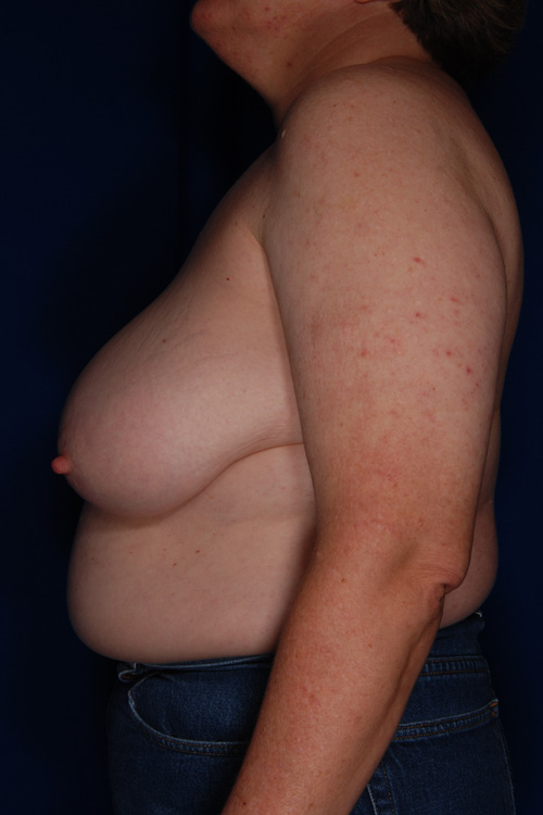 Breast Reduction