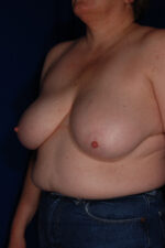 Breast Reduction