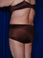 Abdominoplasty