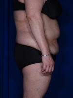 Abdominoplasty