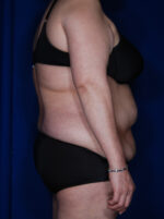 Abdominoplasty