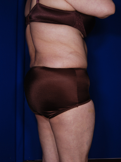 Abdominoplasty