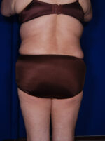 Abdominoplasty