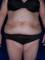 Abdominoplasty