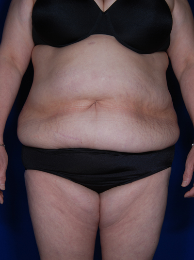 Abdominoplasty