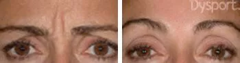 Forehead wrinkles before and after Dysport treatment