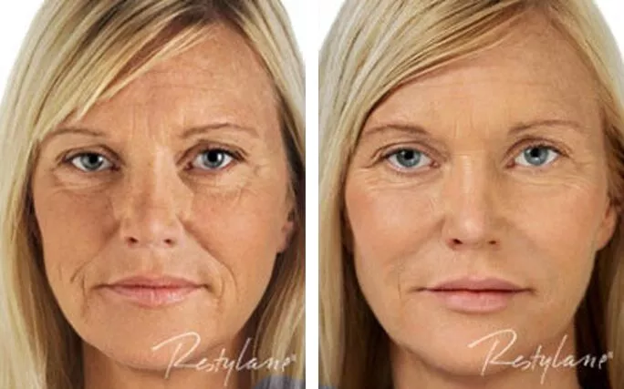 Fillers Volume Restoration ba