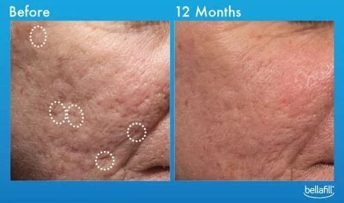 Acne Scar Treatment Danville 3 bellafill before and after 2