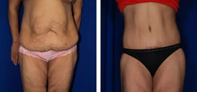 Body Lift (Thigh/Buttocks) 1 body lift ba