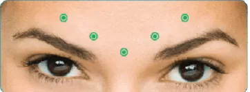 Dysport injection points marked on forehead between eyebrows