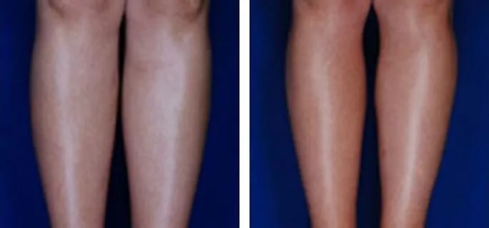 calf ankle ba
