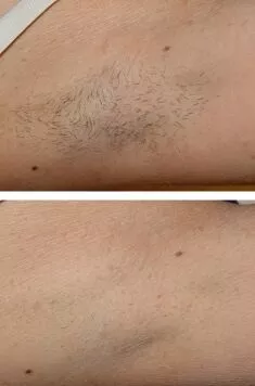 Before and after laser hair removal treatment results