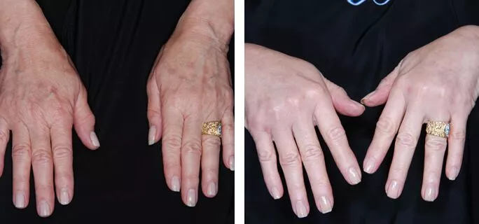 hand rejuvenation ba