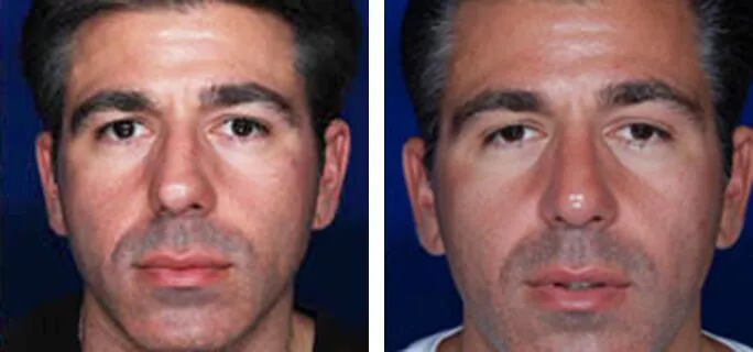 Male rhinoplasty before and after results
