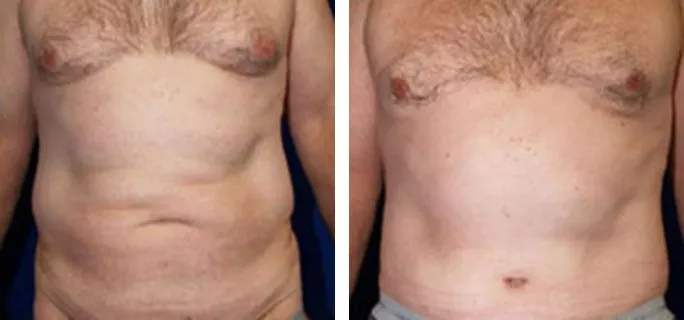 male tummy tuck ba