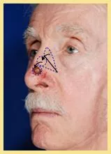 Skin Cancer Reconstruction Danville 2 skin cancer patient1 recon