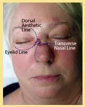 Skin Cancer Reconstruction Danville 5 skin cancer patient3 recon2
