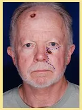 Skin Cancer Reconstruction Danville 7 skin cancer patient4 recon