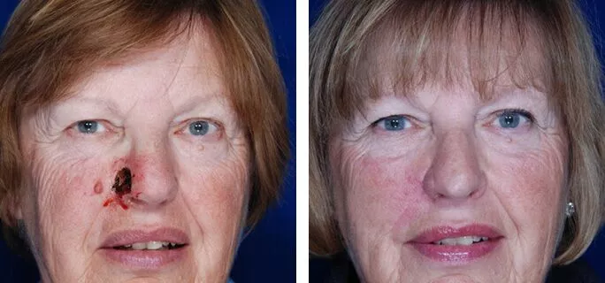 skin cancer reconstruction ba