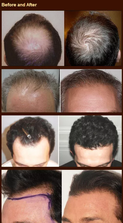 state of the art hair transplant procedure