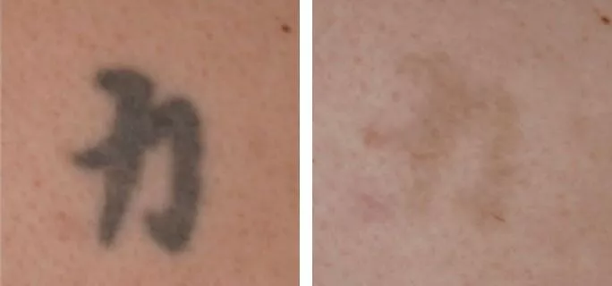 tattoo removal ba