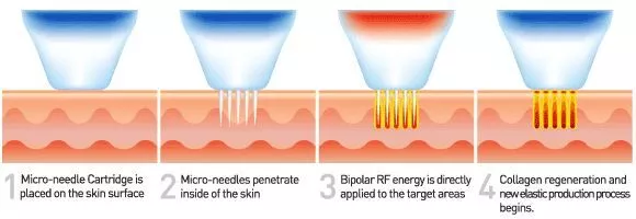 Vivace Micro Needle Danville 1 treatment