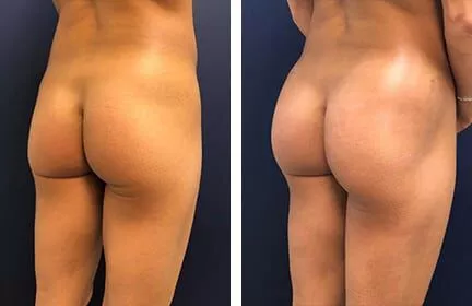 Non Surgical Butt Lift Danville 6 slide1 (1)
