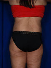 Body Lift