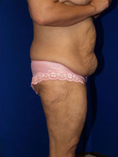 Body Lift