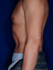 Male Tummy Tuck