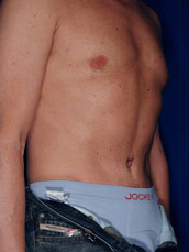 Male Tummy Tuck