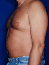 Male Tummy Tuck
