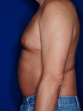 Male Tummy Tuck