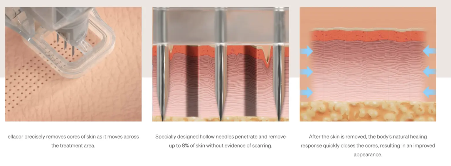 Ellacor treatment process: device removing skin cores, hollow needles penetrating skin, and natural healing response closing