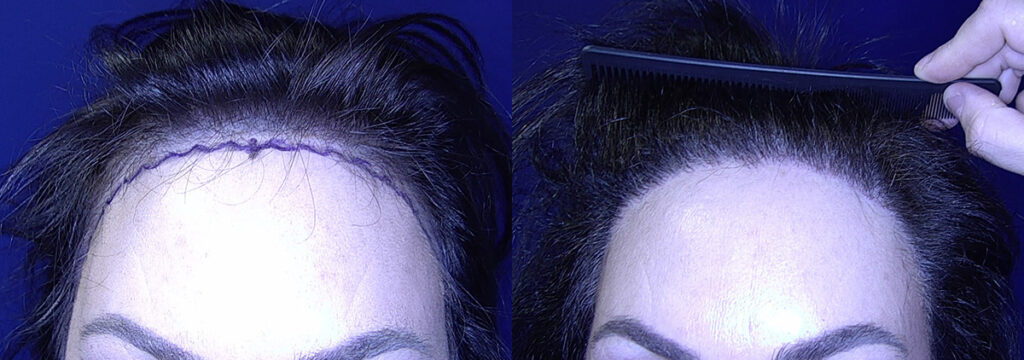 Artas-Before-and-After-Photo-by-Black-Hawk-Hair-Restoration-in-Danville-CA-12