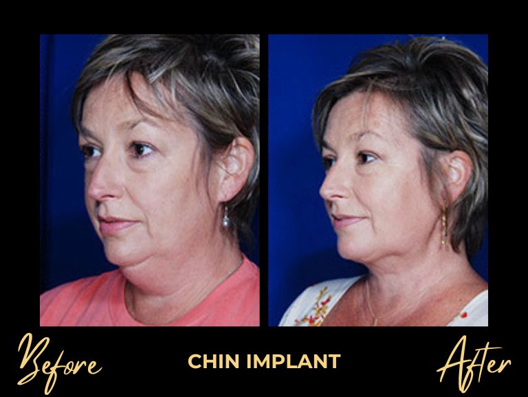 Chin Implant