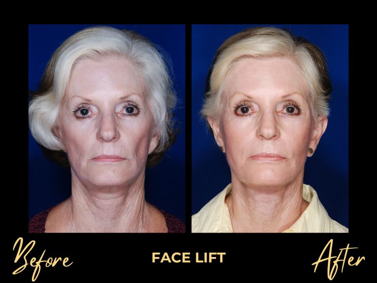 Face Lift