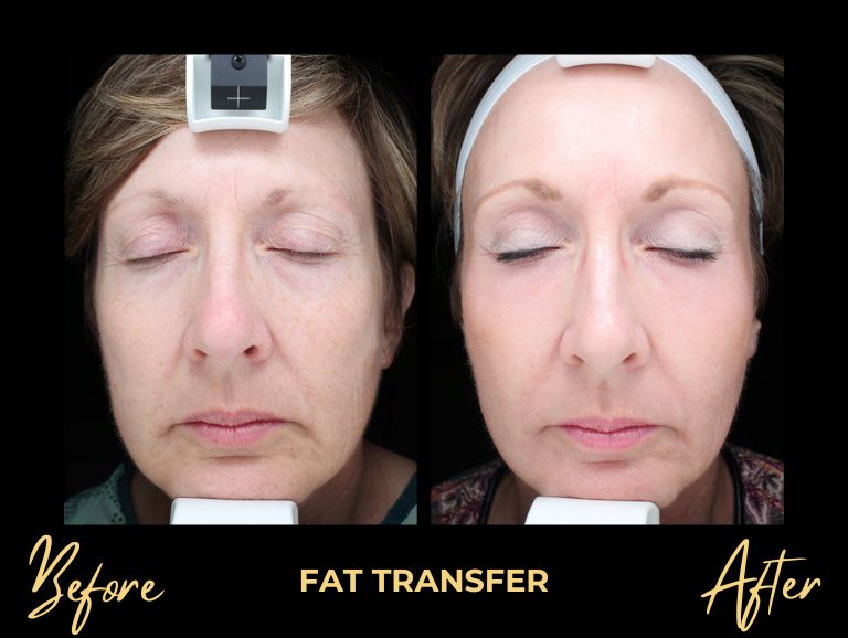 Fat Transfer