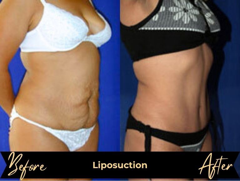 Liposuction