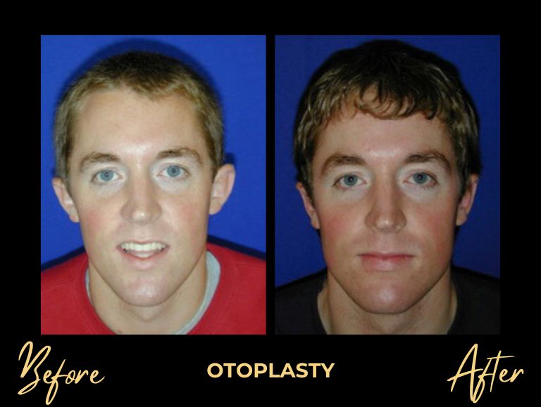 Otoplasty