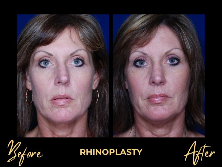 Rhinoplasty