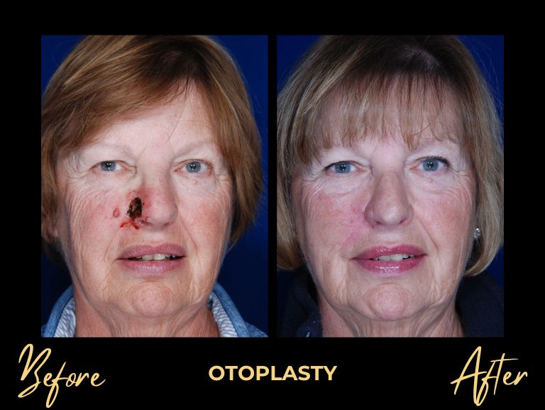 Skin Cancer Reconstruction