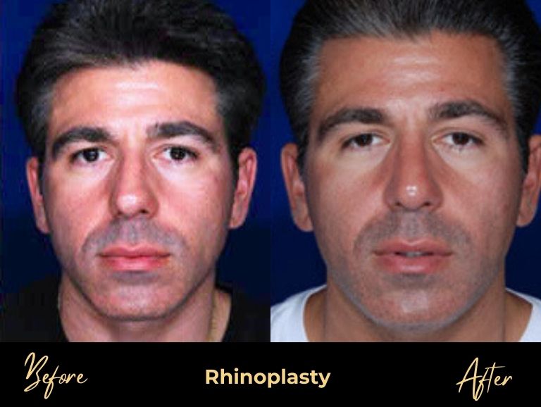 BPS-Male_Procedures-Rhino