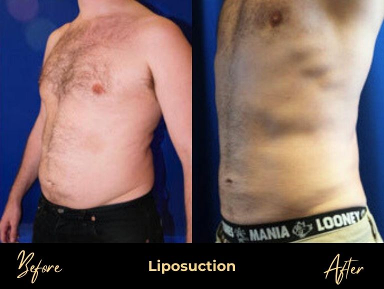 BPS-Male_Procedures5