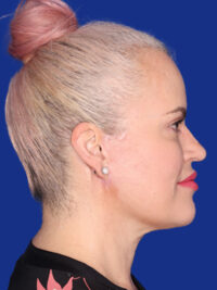 Facelift