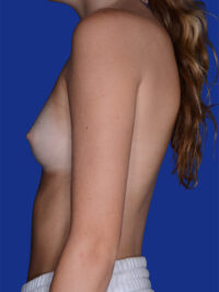 Breast Augmentation