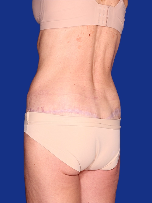 Abdominoplasty