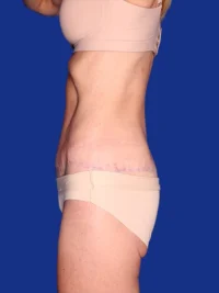 Abdominoplasty